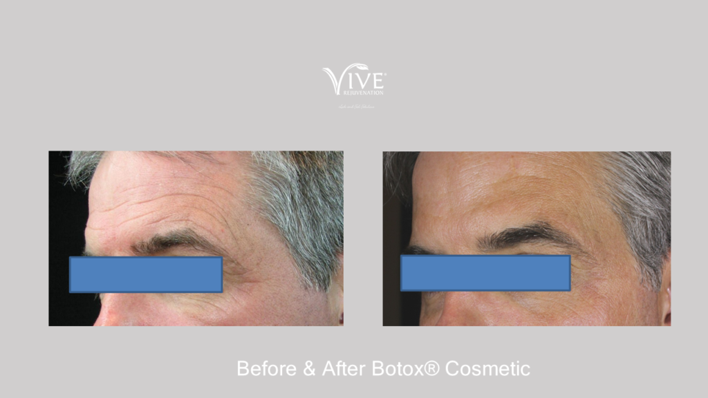 Botox Male