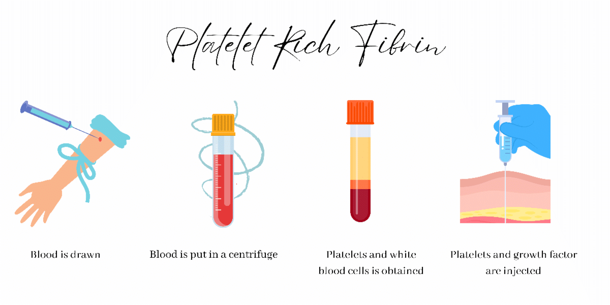 Infographic explaining how PRF works. 