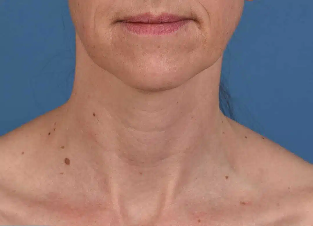 image-microneedling-after-1