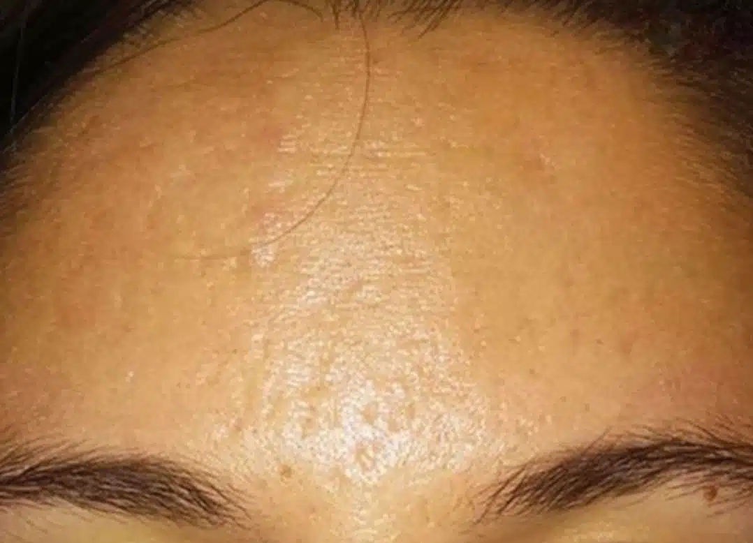 image-microneedling-after-2