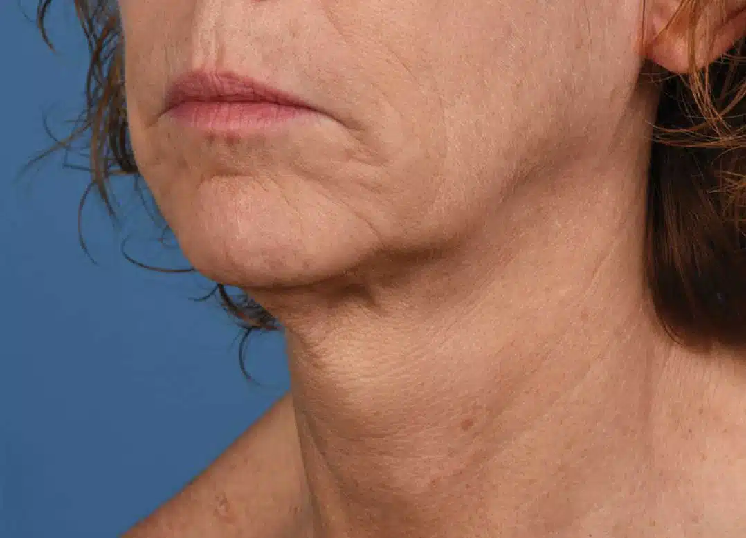 image-microneedling-after-3