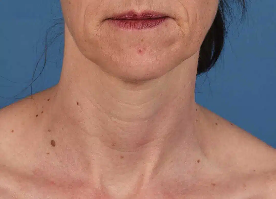 image-microneedling-before-1