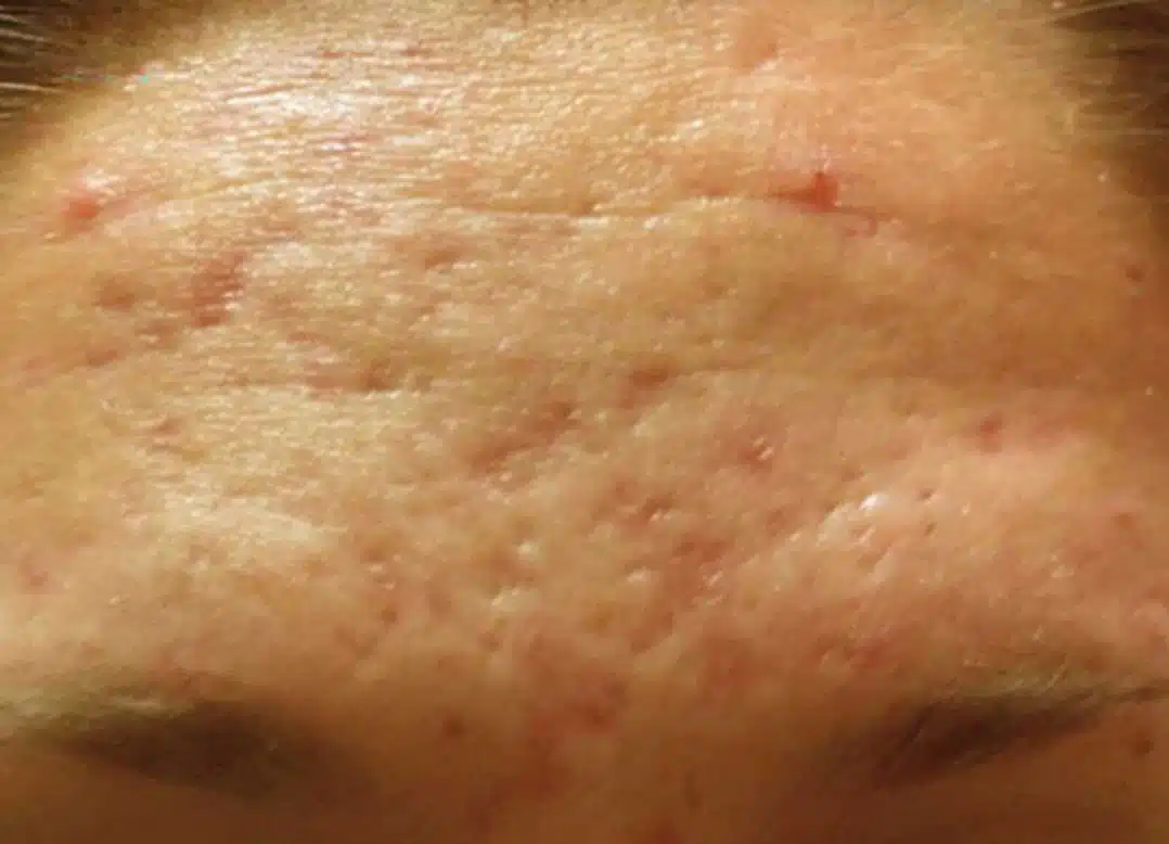 image-microneedling-before-2