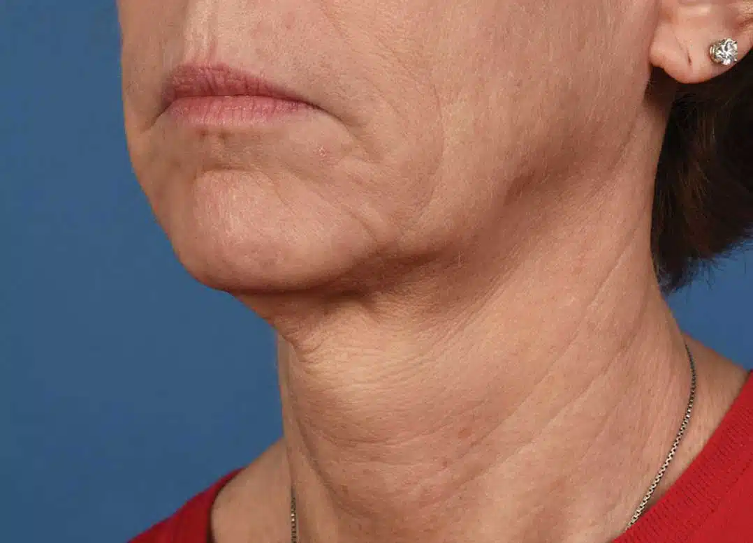 image-microneedling-before-3