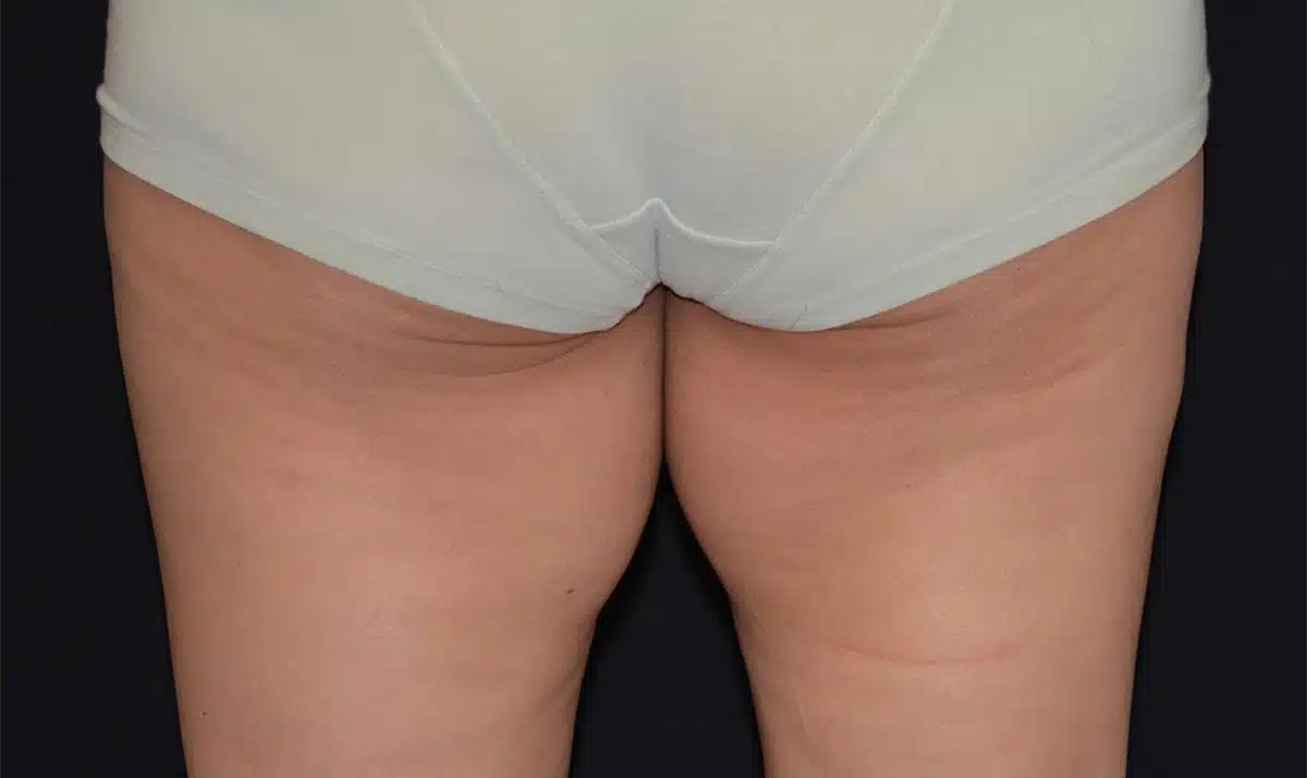 image-coolsculpting-before-7