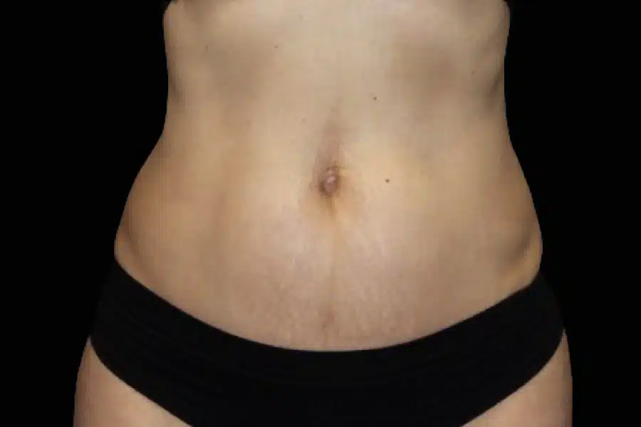 image-cellulite-after-1