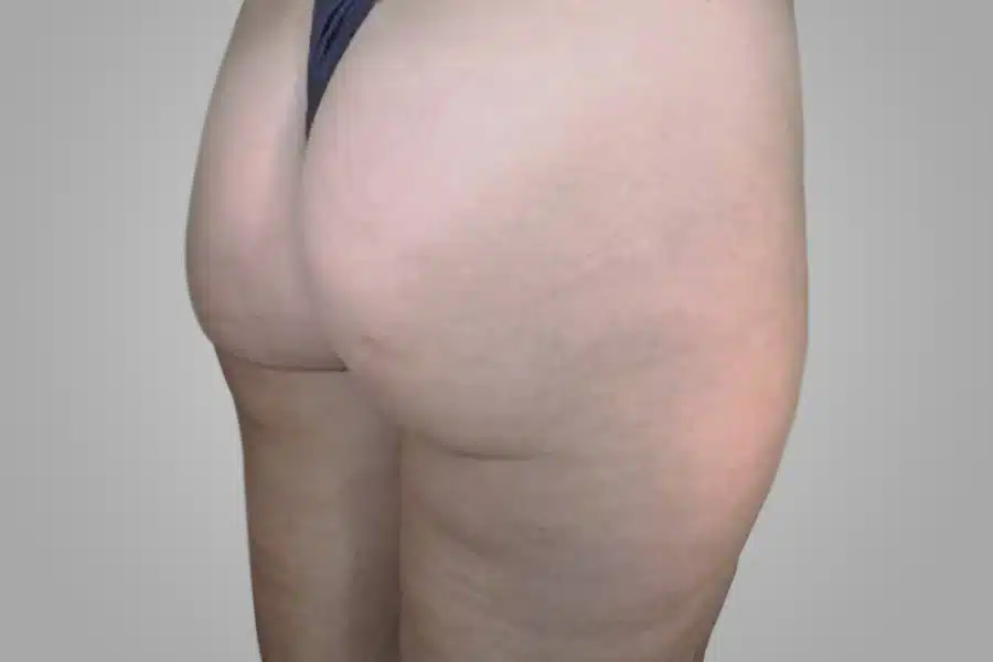 image-cellulite-after-2