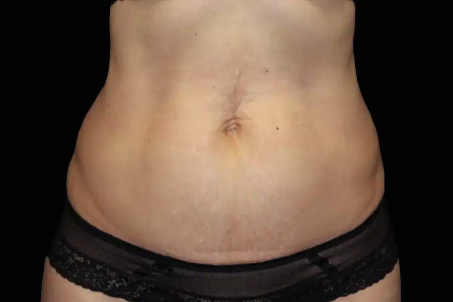 image-cellulite-before-1