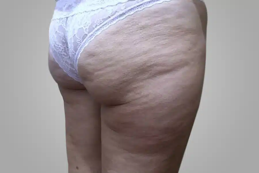 image-cellulite-before-2