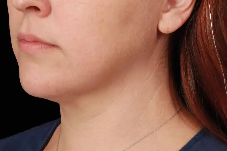 image-double-chin-after-1