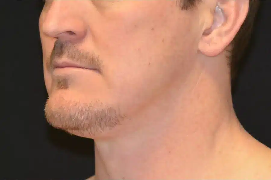 image-double-chin-after-2