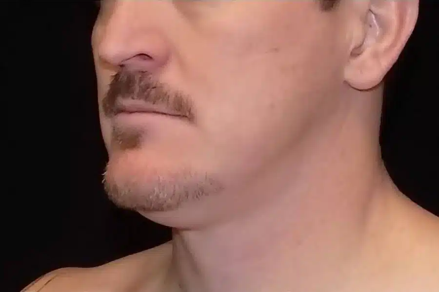 image-double-chin-before-2