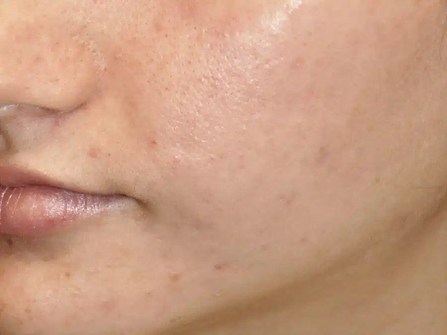 image-rosacea-after