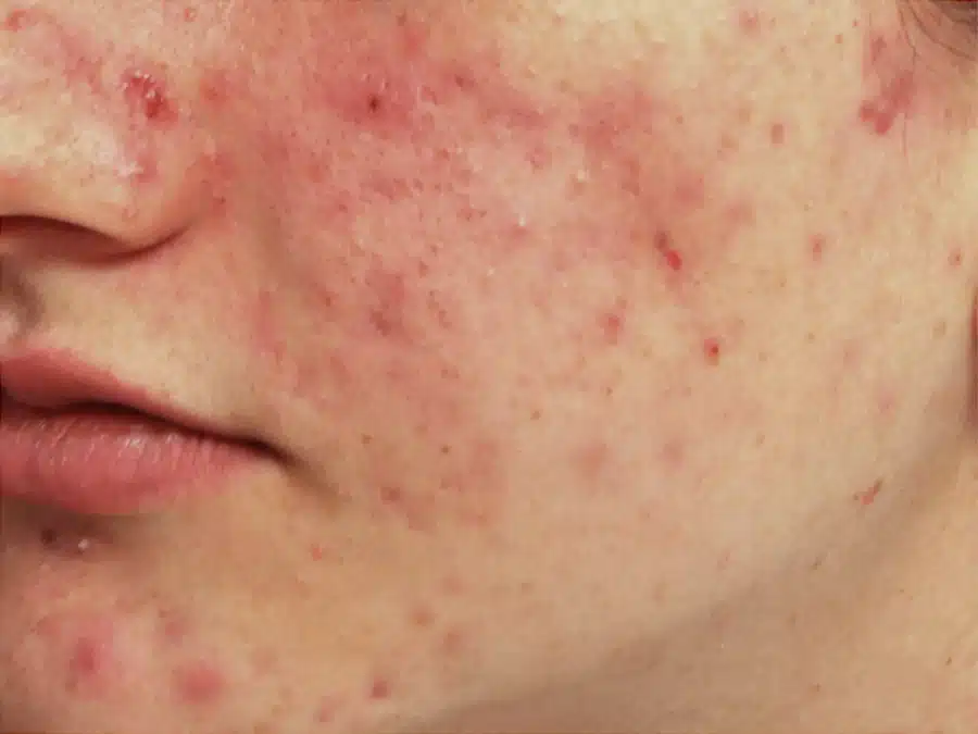 image-rosacea-before