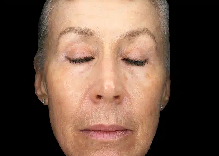 image-exion-clear-before-after-1_after