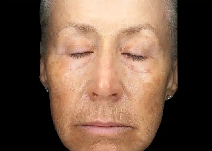 image-exion-clear-before-after-1_before