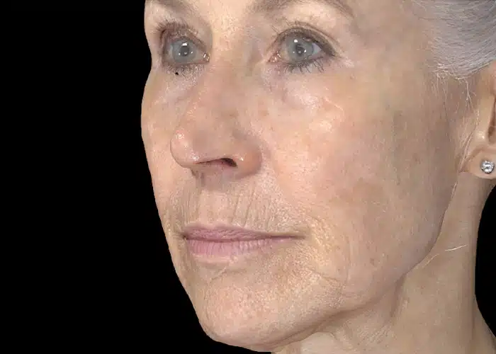 image-exion-clear-before-after-2_after