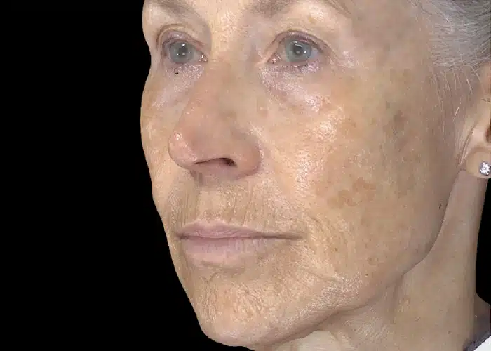 image-exion-clear-before-after-2_before