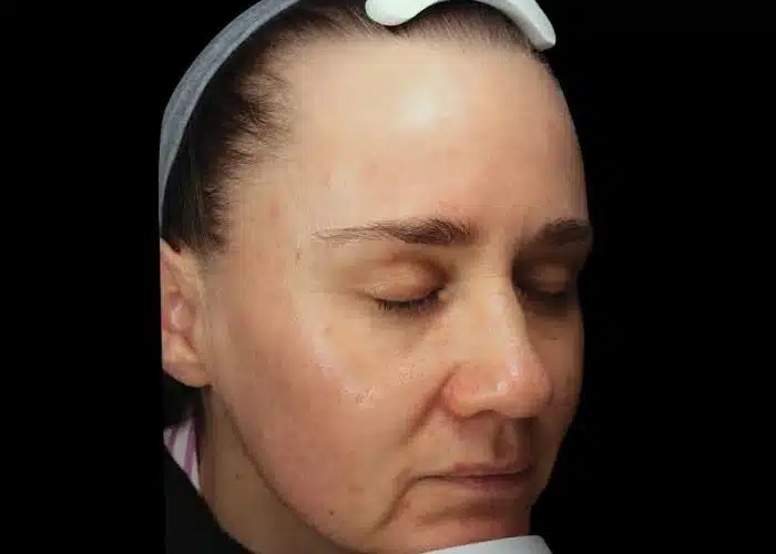 image-exion-clear-before-after-3_after