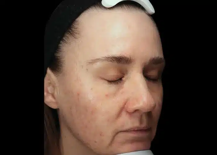 image-exion-clear-before-after-3_before