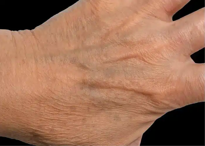 image-exion-clear-before-after-4_after