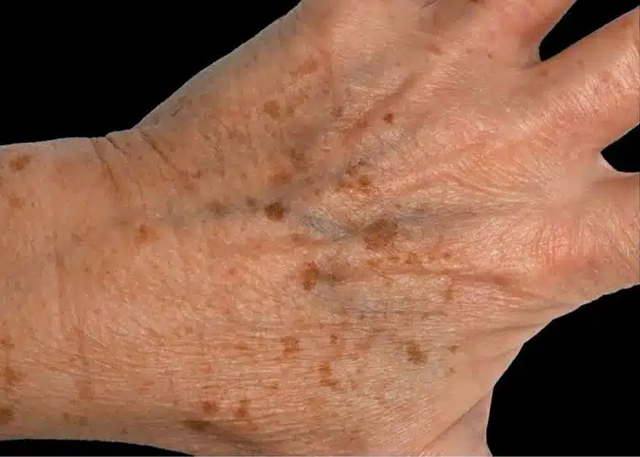 image-exion-clear-before-after-4_before