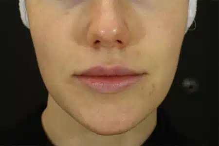 image-hollywood-facial-before-after-1_after