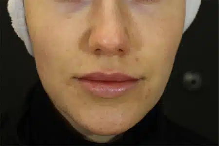 image-hollywood-facial-before-after-1_before