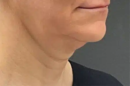 image-hollywood-facial-before-after-2_before