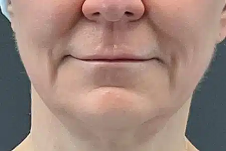 image-hollywood-facial-before-after-3_after