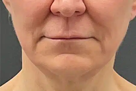 image-hollywood-facial-before-after-3_before