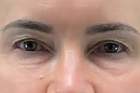 image-hollywood-facial-before-after-4_after