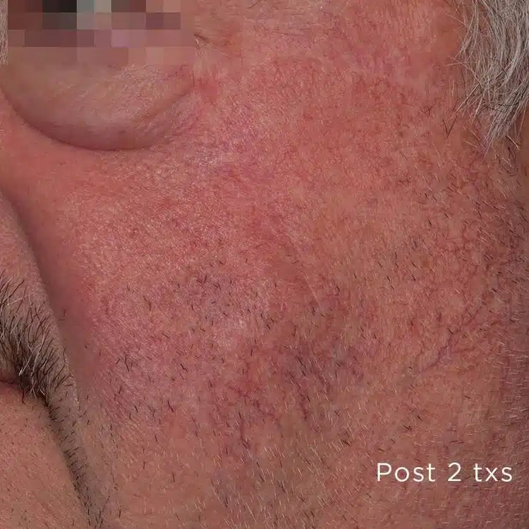 image-laser-vein-before-1_after