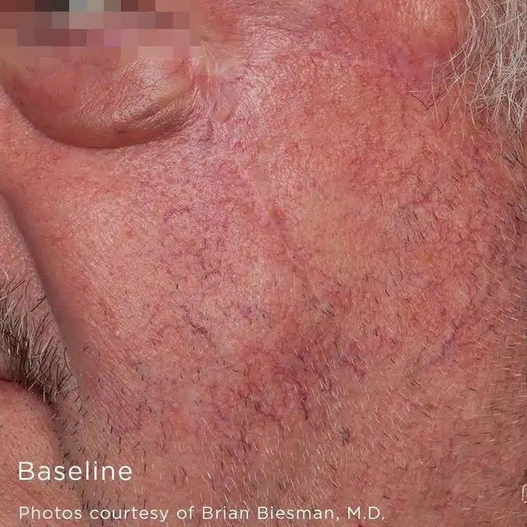 image-laser-vein-before-1_before