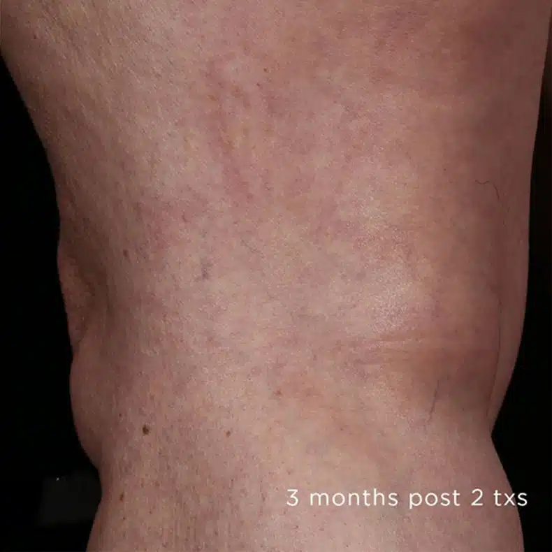image-laser-vein-before-2_after
