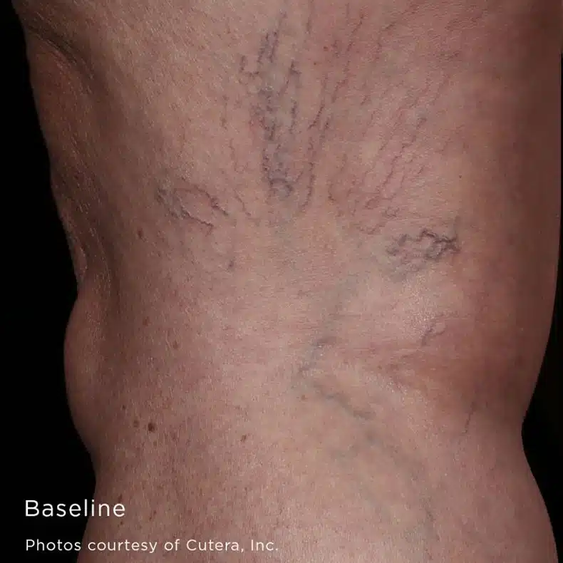 image-laser-vein-before-2_before