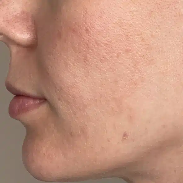 image-limelight-before-after-1_after