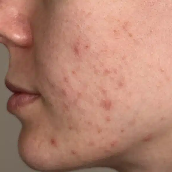 image-limelight-before-after-1_before