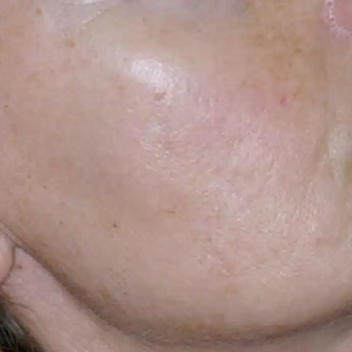 image-limelight-before-after-2_after