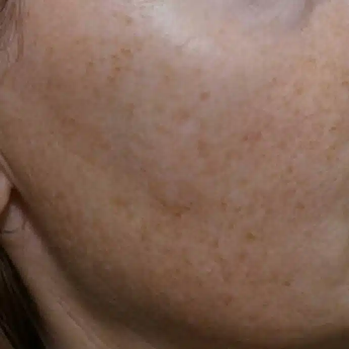 image-limelight-before-after-2_before