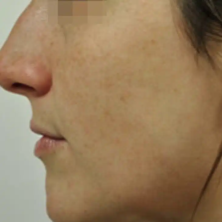 image-limelight-before-after-3_after