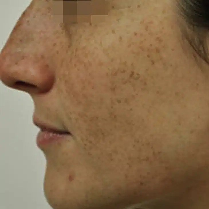 image-limelight-before-after-3_before