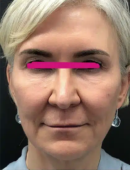 image-prp-before-after-1_after