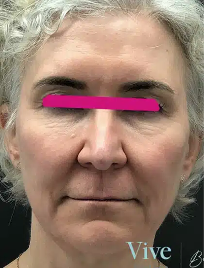 image-prp-before-after-1_before