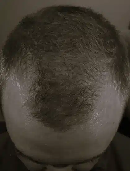 image-prp-before-after-2_after