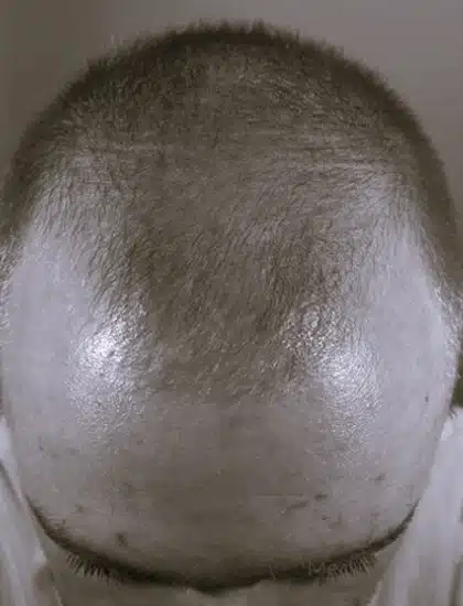 image-prp-before-after-2_before