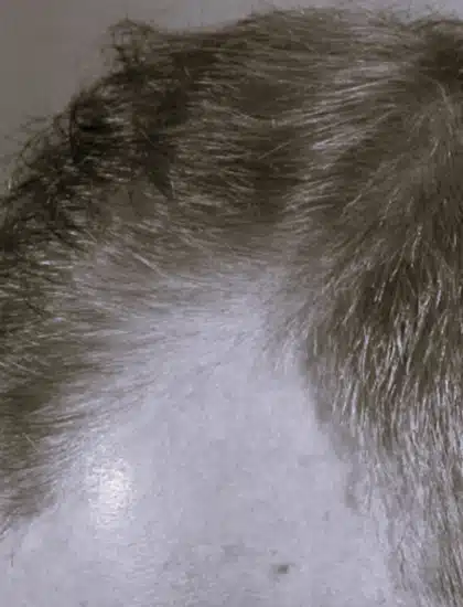 image-prp-before-after-3_after