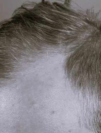 image-prp-before-after-3_before