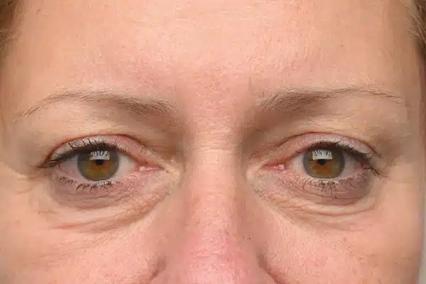 image-undereye-before-1
