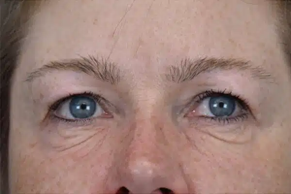 image-undereye-before-2